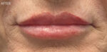 Lip Augmentation