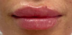 Lip Augmentation