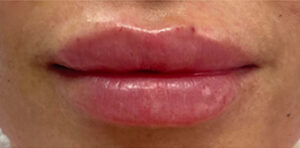 Lip Augmentation Case 10346 After Photo Lip Augmentation