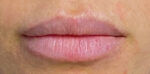 Lip Augmentation