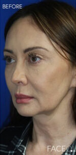 FACEology Lift / Neck Lift