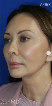 FACEology Lift / Neck Lift