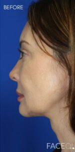 FACEology Lift / Neck Lift