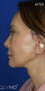 FACEology Lift / Neck Lift