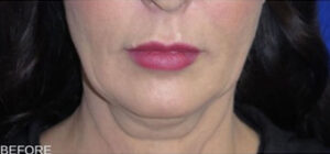 FACEology Lift / Neck Lift