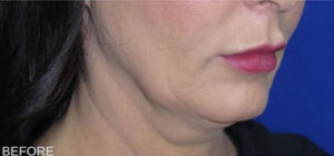 FACEology Lift / Neck Lift