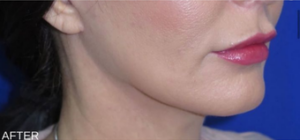 FACEology Lift / Neck Lift