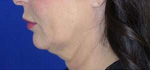 FACEology Lift / Neck Lift