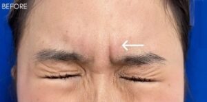 Botox Case 10351 Before Photo Botox