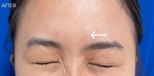 Botox Case 10351 After Photo Botox