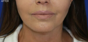 FACEology Lift / Neck Lift