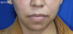 FACEology Lift / Neck Lift