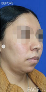 FACEology Lift / Neck Lift