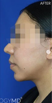 FACEology Lift / Neck Lift