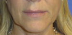 FACEology Lift / Neck Lift