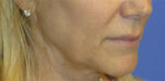 FACEology Lift / Neck Lift