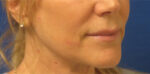 FACEology Lift / Neck Lift