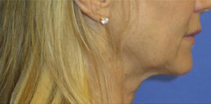 FACEology Lift / Neck Lift Case 11074 Before Photo FACEology Lift / Neck Lift