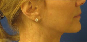 FACEology Lift / Neck Lift Case 11074 After Photo FACEology Lift / Neck Lift