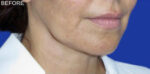 FACEology Lift / Neck Lift