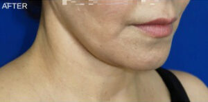 FACEology Lift / Neck Lift