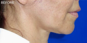 FACEology Lift / Neck Lift Case 11076 Before Photo FACEology Lift / Neck Lift