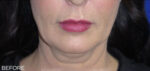 FACEology Lift / Neck Lift