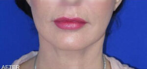 FACEology Lift / Neck Lift