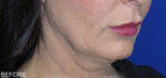 FACEology Lift / Neck Lift