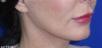 FACEology Lift / Neck Lift