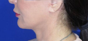 FACEology Lift / Neck Lift Case 11079 After Photo FACEology Lift / Neck Lift