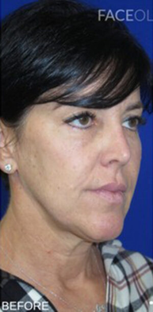 FACEology Lift / Neck Lift Case 11080 Before Photo FACEology Lift / Neck Lift