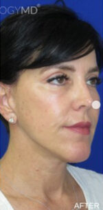 FACEology Lift / Neck Lift