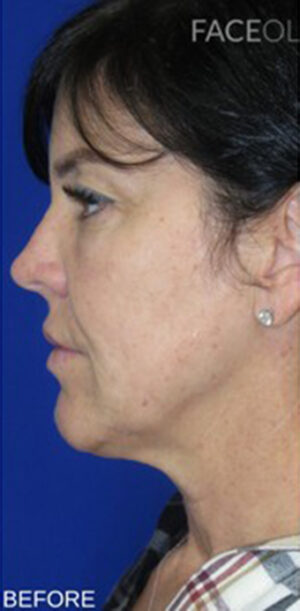 FACEology Lift / Neck Lift