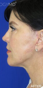 FACEology Lift / Neck Lift