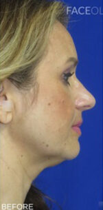 FACEology Lift / Neck Lift