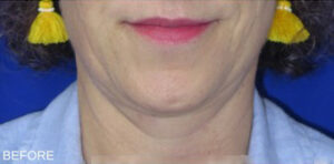 FACEology Lift / Neck Lift