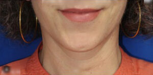 FACEology Lift / Neck Lift Case 11082 After Photo FACEology Lift / Neck Lift