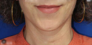 FACEology Lift / Neck Lift