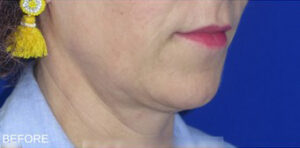 FACEology Lift / Neck Lift