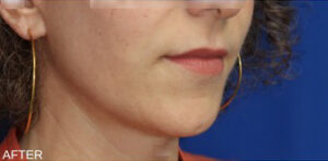 FACEology Lift / Neck Lift