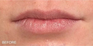 Lip Augmentation Case 11077 Before Photo Lip Augmentation