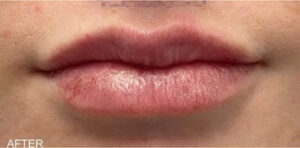 Lip Augmentation Case 11077 After Photo Lip Augmentation