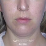 Chin Liposuction