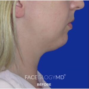 Chin Liposuction