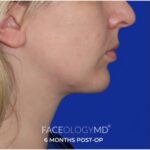 Chin Liposuction