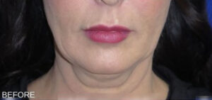 FACEology Lift / Neck Lift