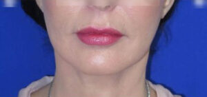 FACEology Lift / Neck Lift