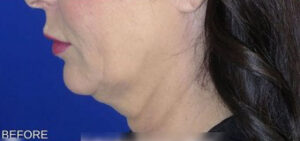 FACEology Lift / Neck Lift