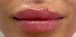 Lip Augmentation